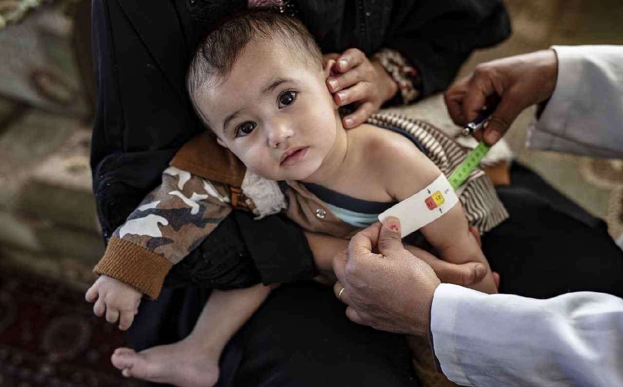 Afghan children besieged by measles and malnutrition